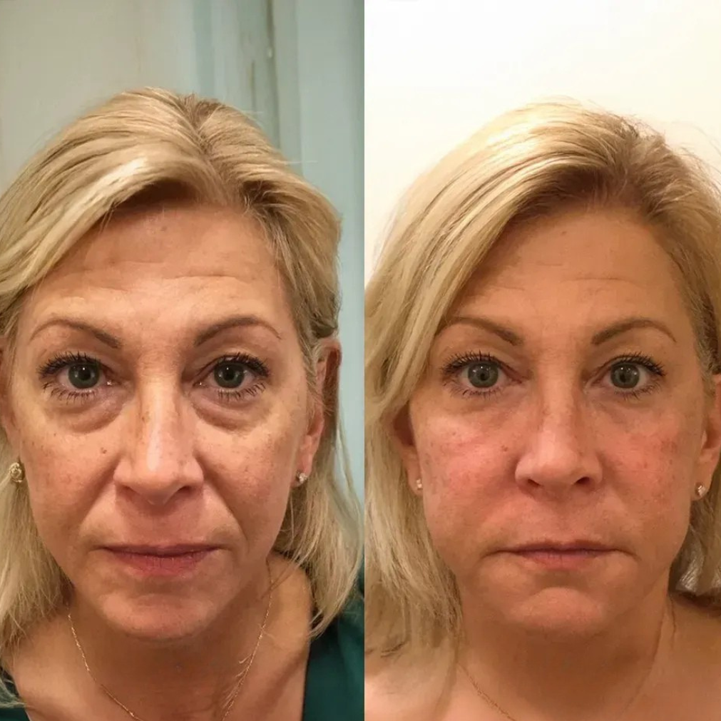 RadiantlyLift - Gel Reafirmante Antiarrugas con Efecto Lifting Instantáneo